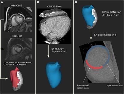 Radiomics and Machine Learning for Detecting Scar Tissue on CT Delayed Enhancement Imaging